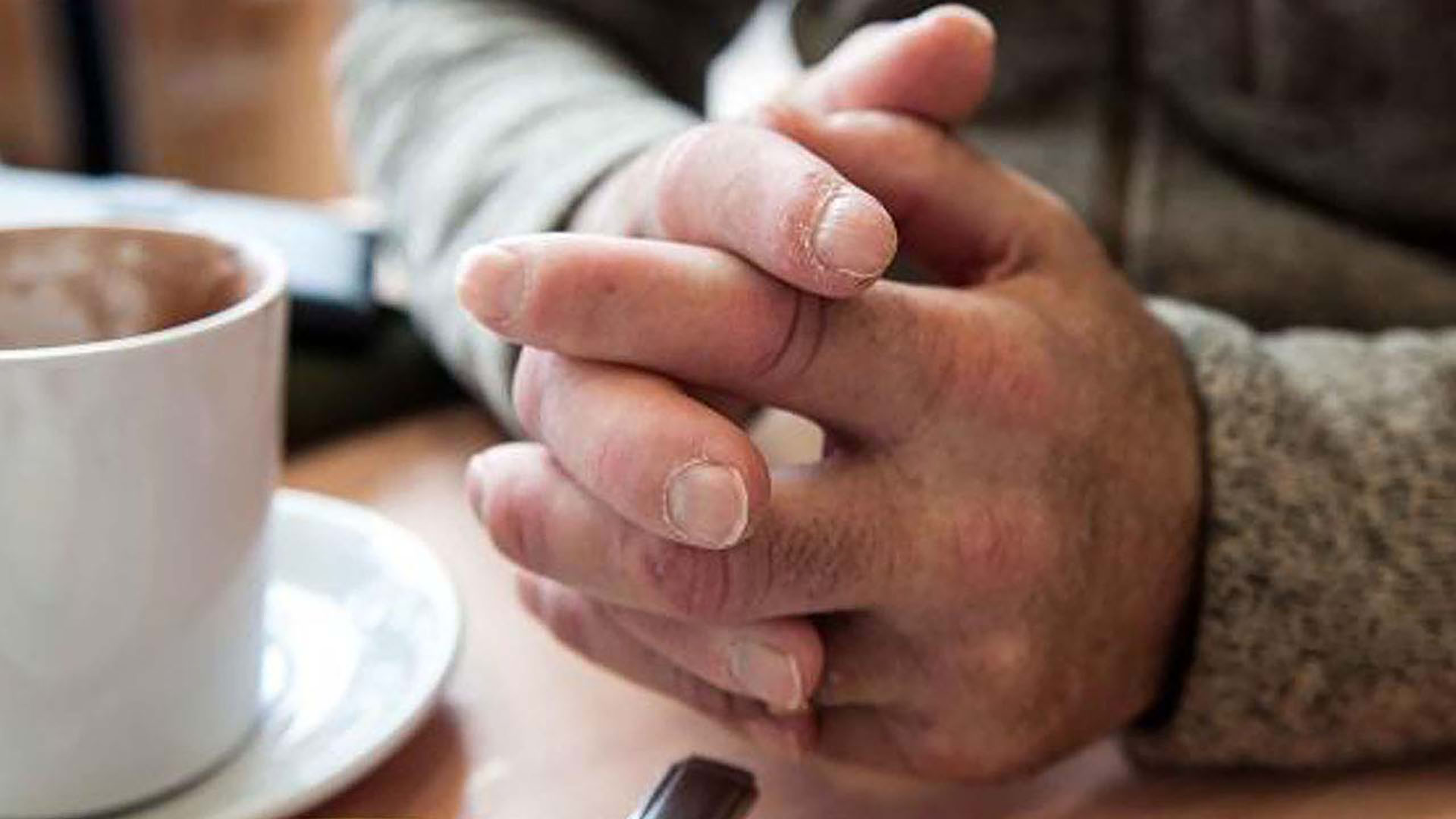 Opsvulmede hænder og fingre