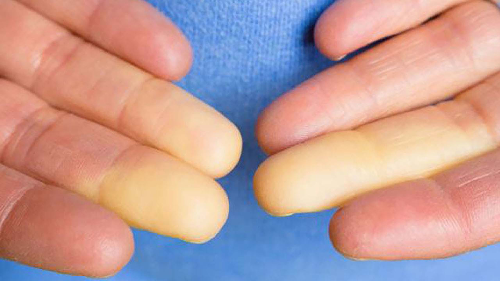 Raynaud’s fænomen