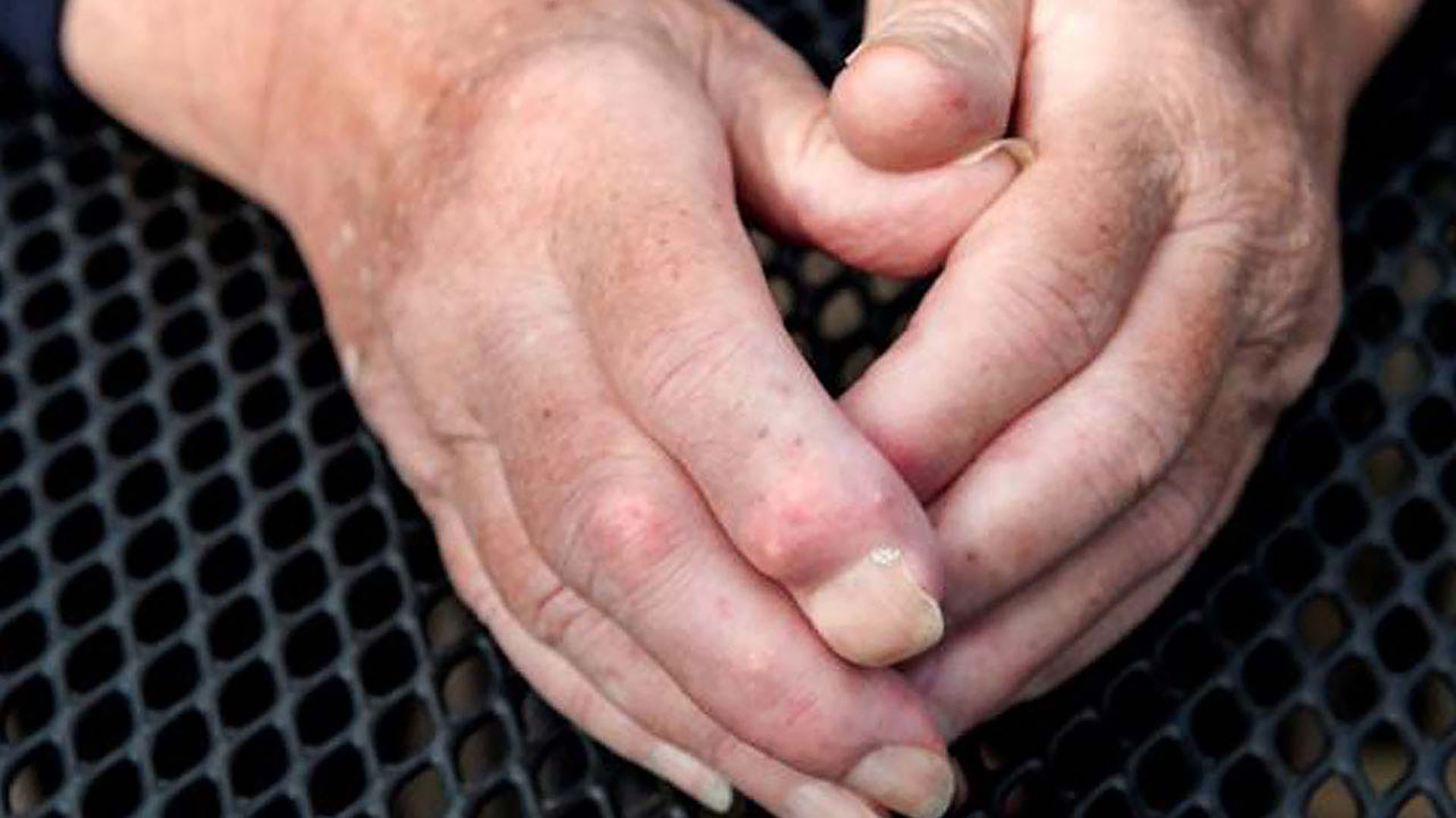 Hårde knuder (calcinosis)